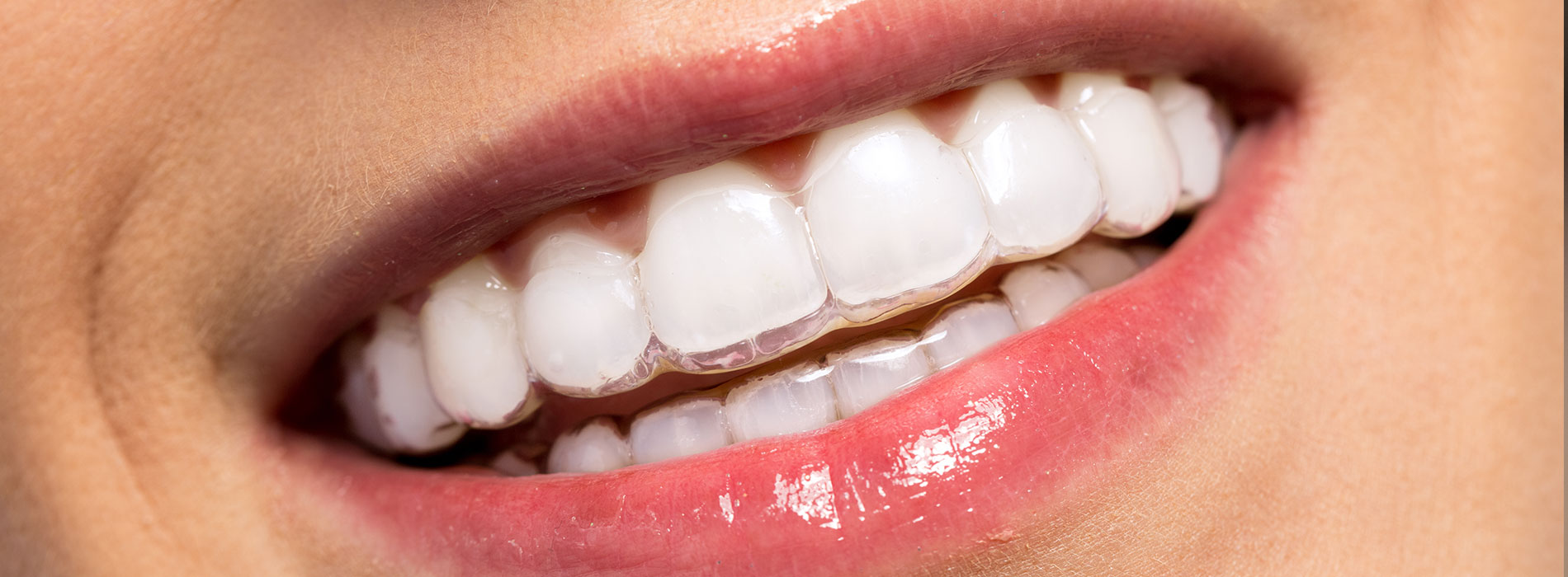 The image displays a close-up of a person s smiling face with white teeth, wearing lipstick.
