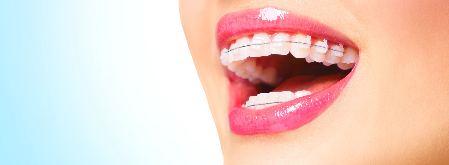 The image depicts a person with a wide smile showcasing their teeth, set against a plain background.